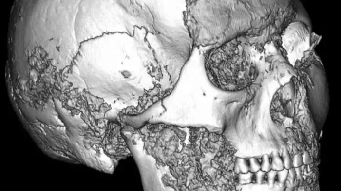 Los restos de una momia siberiana de 2500 años muestran una cirugía de mandíbula completamente desconcertante