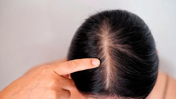 La caída del cabello en adolescentes: ¿peinados tirantes y fármacos para adelgazar como culpables?