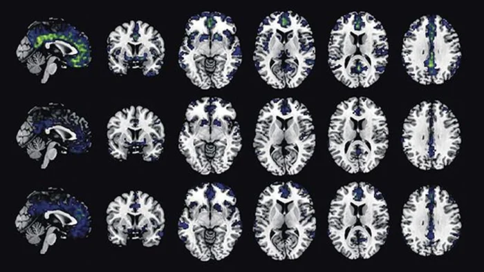 Nuevas Dudas sobre la Eficacia de Fármacos contra el Alzhéimer